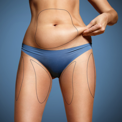 The midsection of a caucasian woman wearing bikini bottoms and markings for liposuction