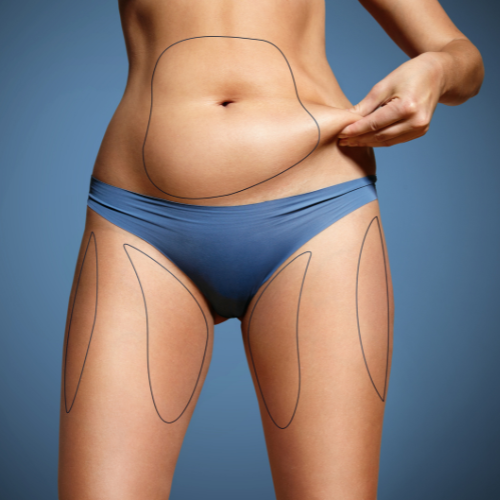 Best Mini Tummy Tuck- Dallas-Top Plastic Surgeon, Dr. John Burns – Dr John  Burns