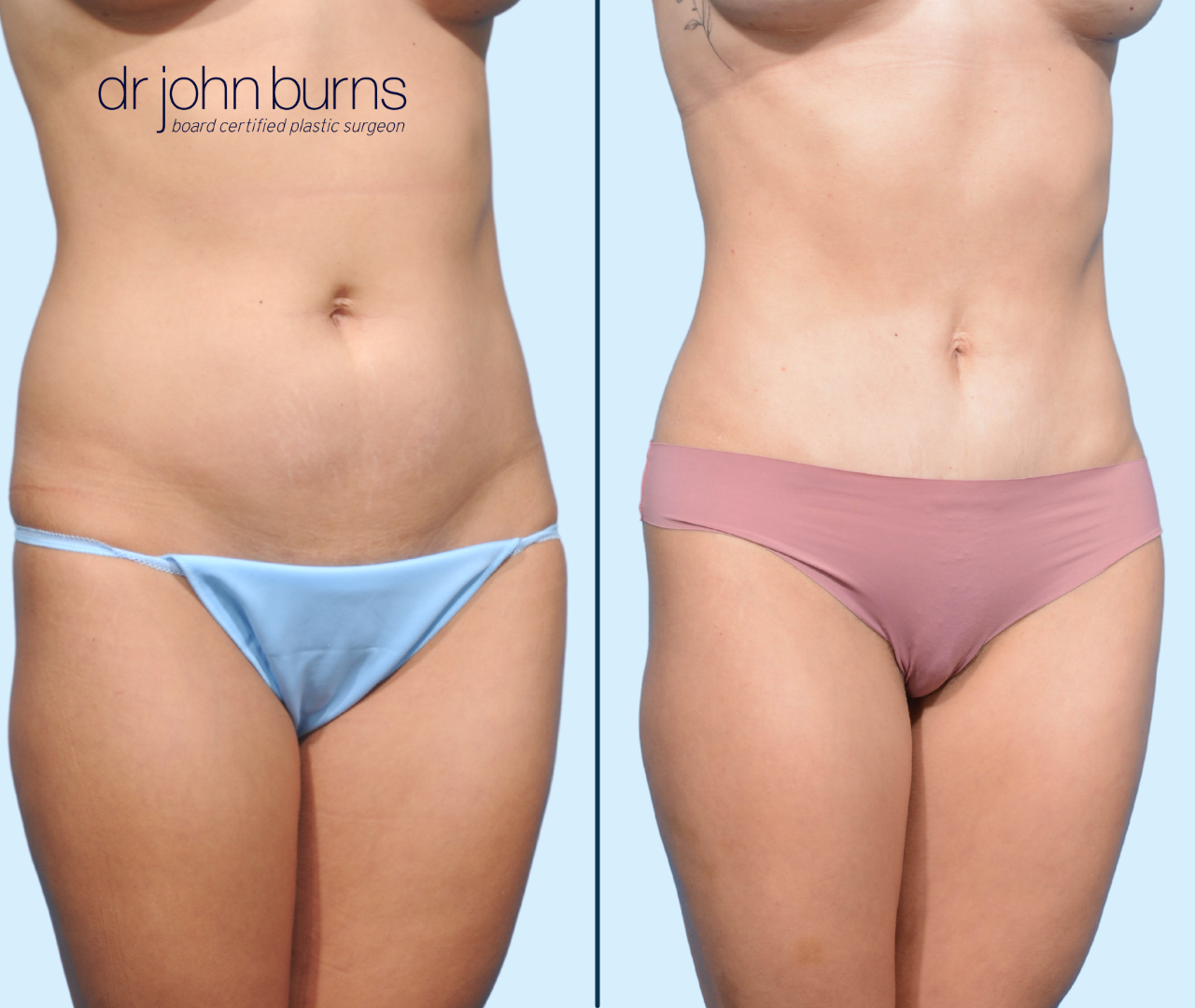 Before & After Corset Mini Tummy Tuck with Lipo 360 by Dallas Plastic Surgeon, Dr. John Burns