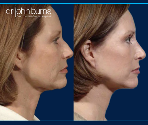 Before and After Profile View of a Mini Facelift with Rhinoplasty and Laser Resurfacing