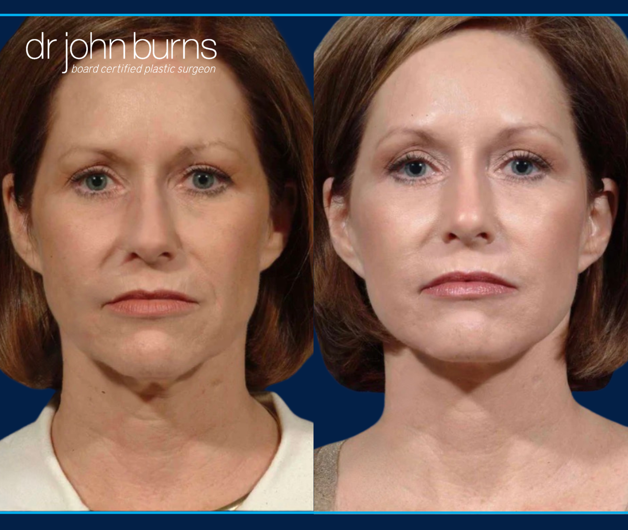 Before and after facelift by Dallas Facelift Specialist, Dr. John Burns