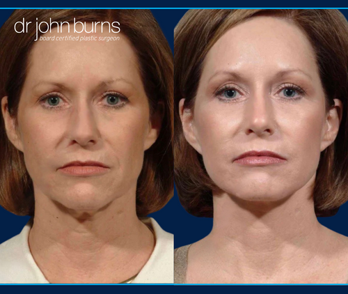 Before and After a Mini Facelift with Rhinoplasty and Laser Resurfacing