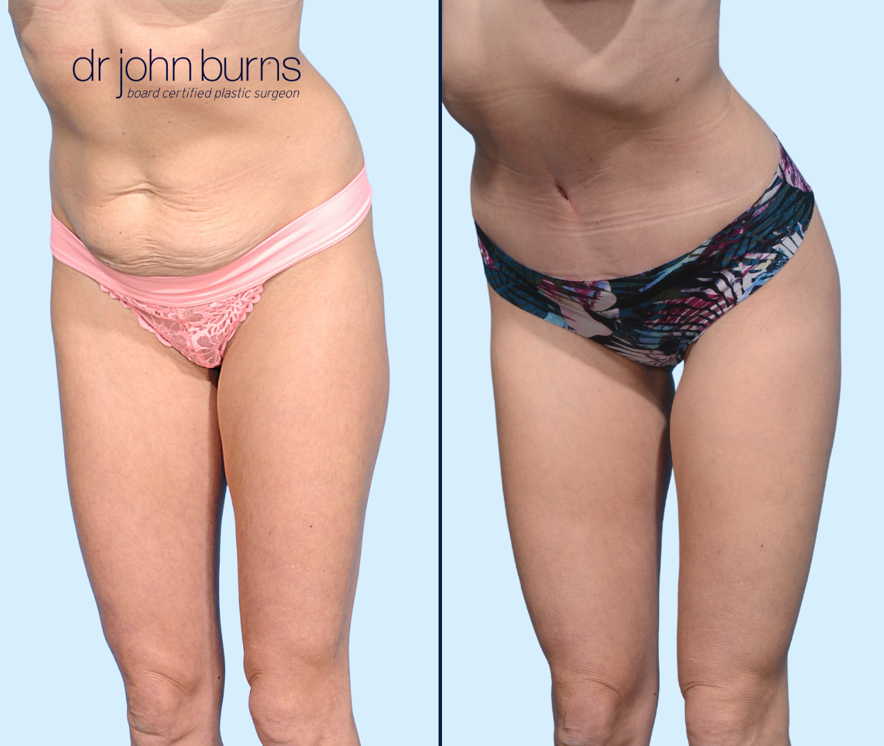 Before and After Dallas Mini Tummy Tuck with Lipo 360 by Dr. John Burns