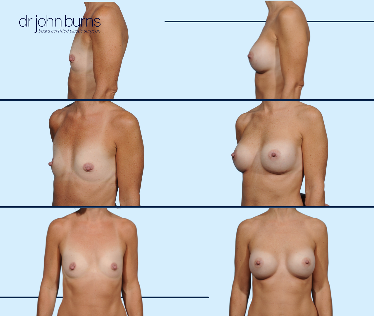 Dallas Breast Implants- Before and After Breast Implants in Dallas, Texas