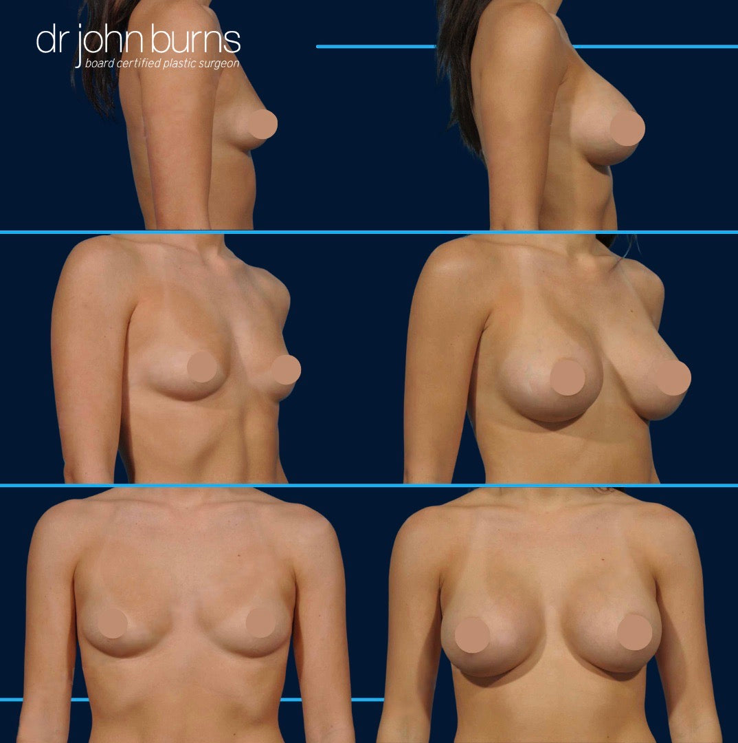 before and after breast implants in dallas, tx by Dr. John Burns