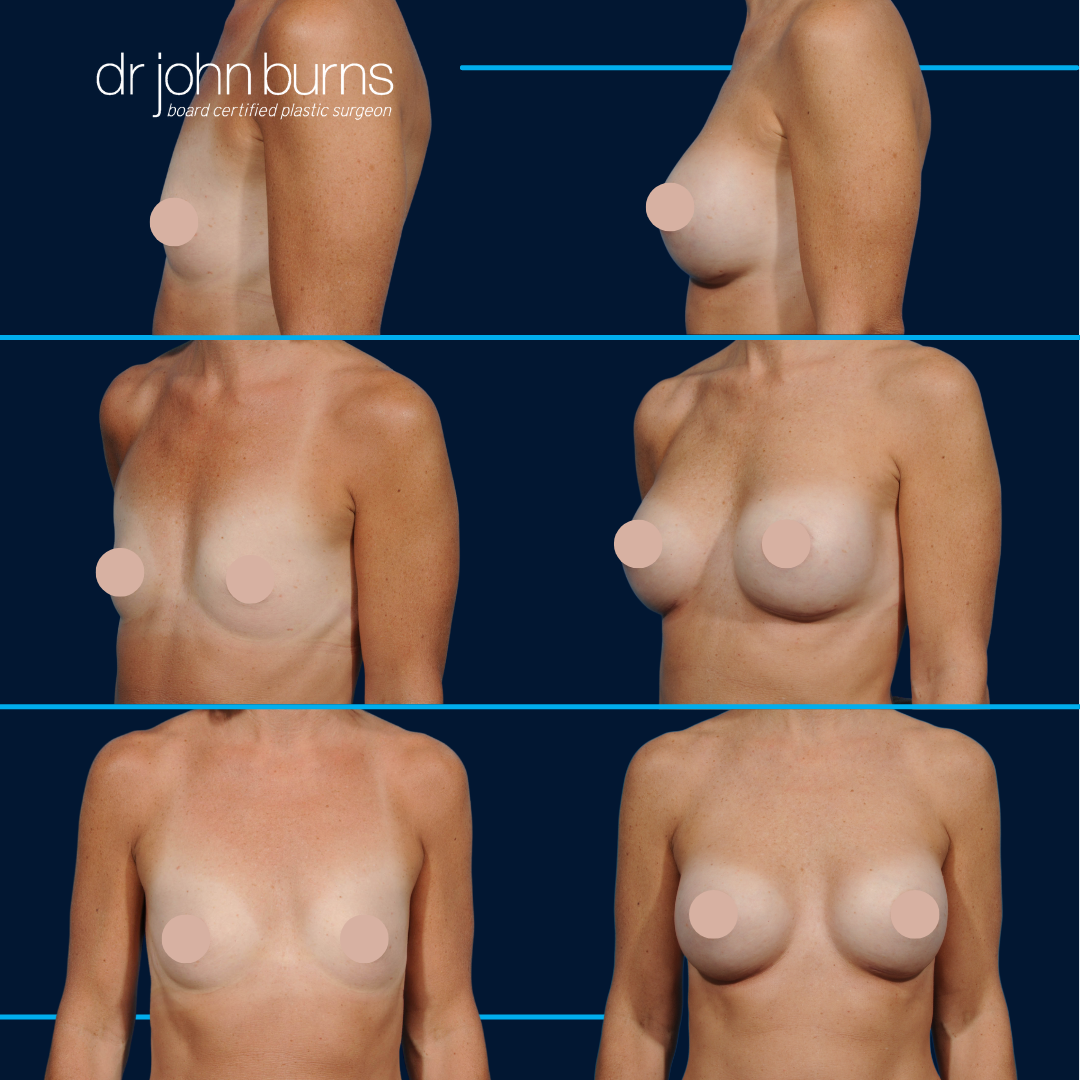 before and after breast implants in dallas, tx by Dr. John Burns