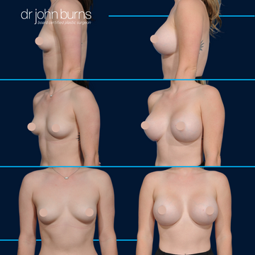 A to C cup breast augmentation by Dr. John Burns
