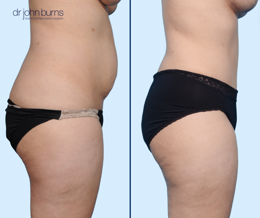 Profil View | Tummy Tuck Before & After by Dallas Plastic Surgeon, Dr John Burns