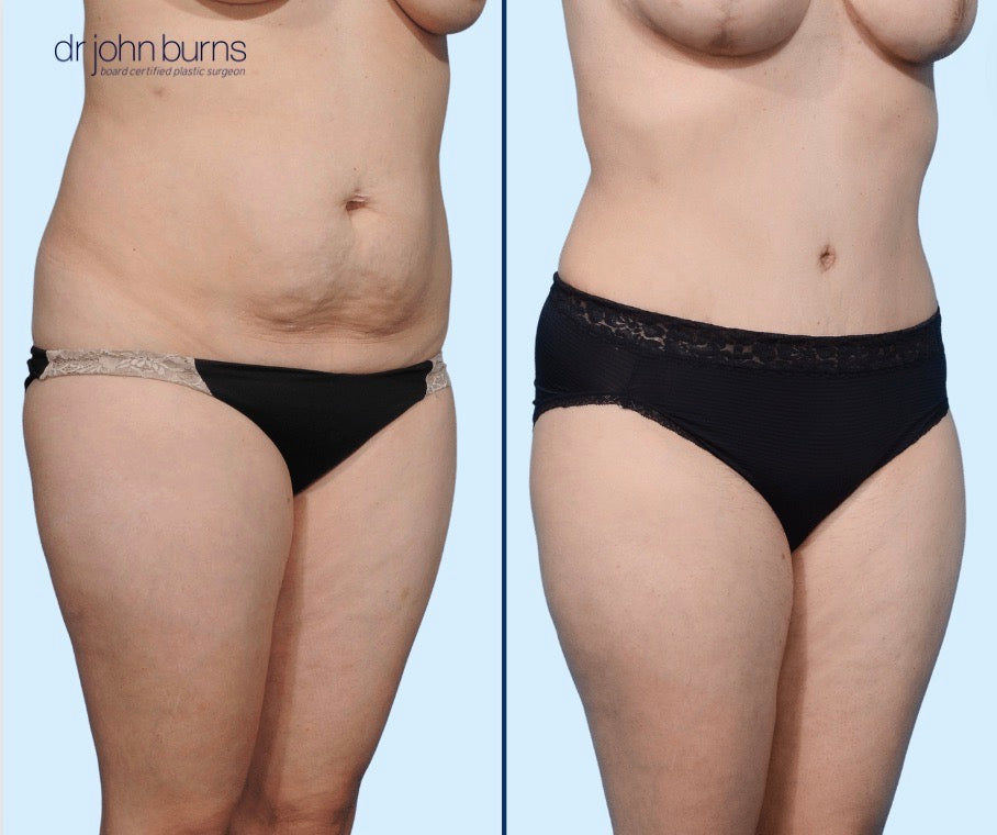 45 Degree View |  Tummy Tuck Before & After by Dallas Plastic Surgeon, Dr John Burns