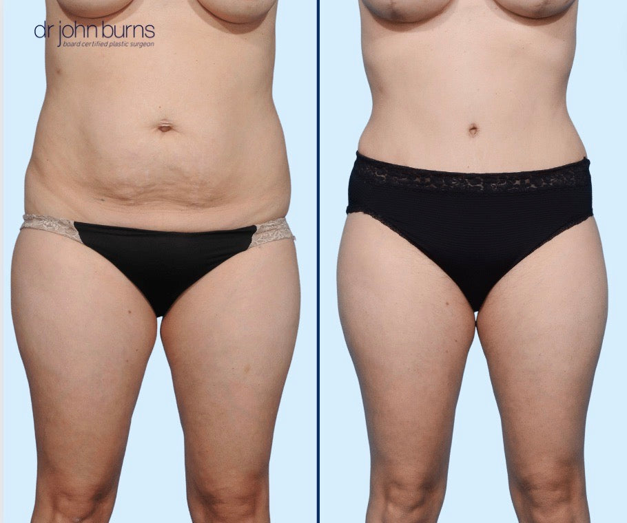 Frontal View | Before & After Tummy Tuck with Lipo by Dr. John Burns