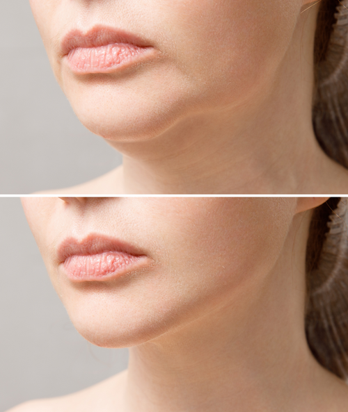 Before and After of a jawline that has had facelift surgery against a grey background