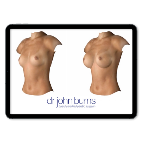 Apple iPad with Before and After breast implants