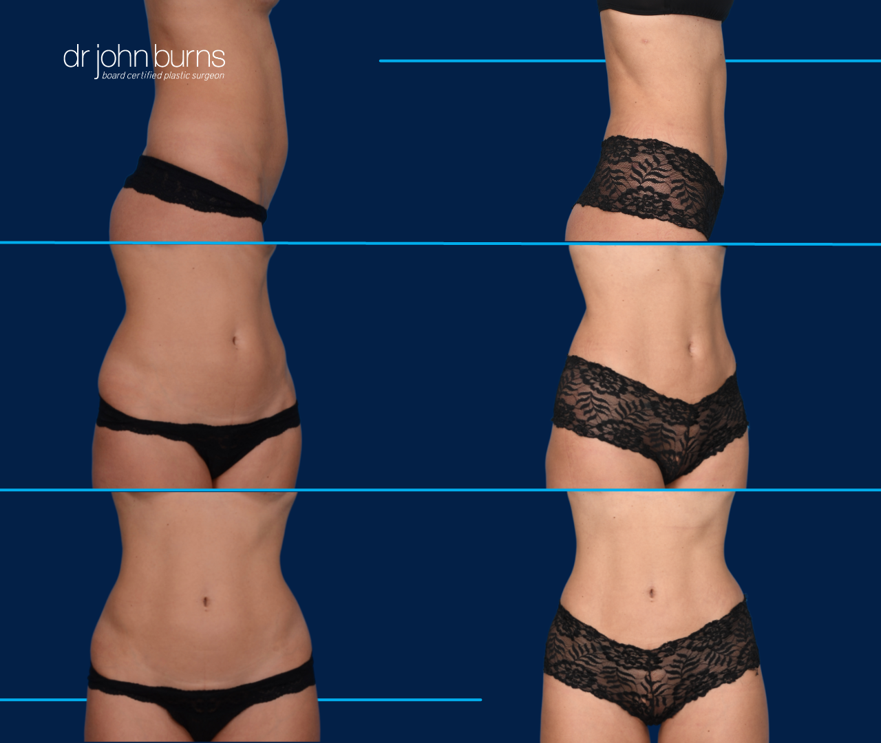 Before & After Mini Tummy Tuck with Abdominal Etching by Dallas Plastic Surgeon, Dr. John Burns