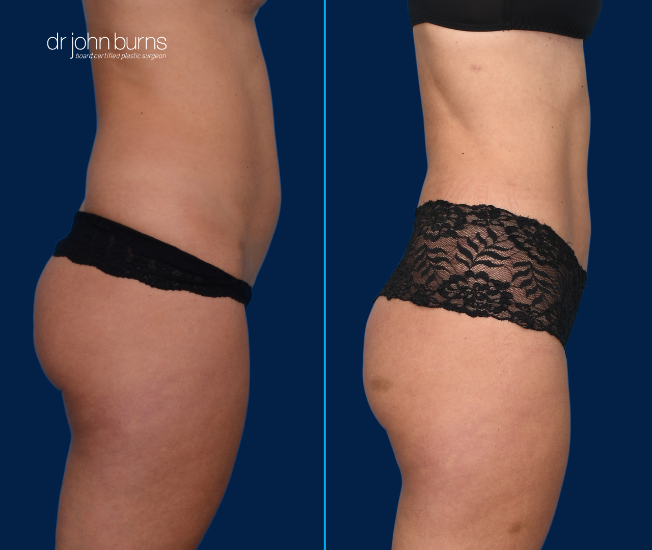 Profile View | Before & After Mini Tummy Tuck with Abdominal Etching by Dallas Plastic Surgeon, Dr. John Burns
