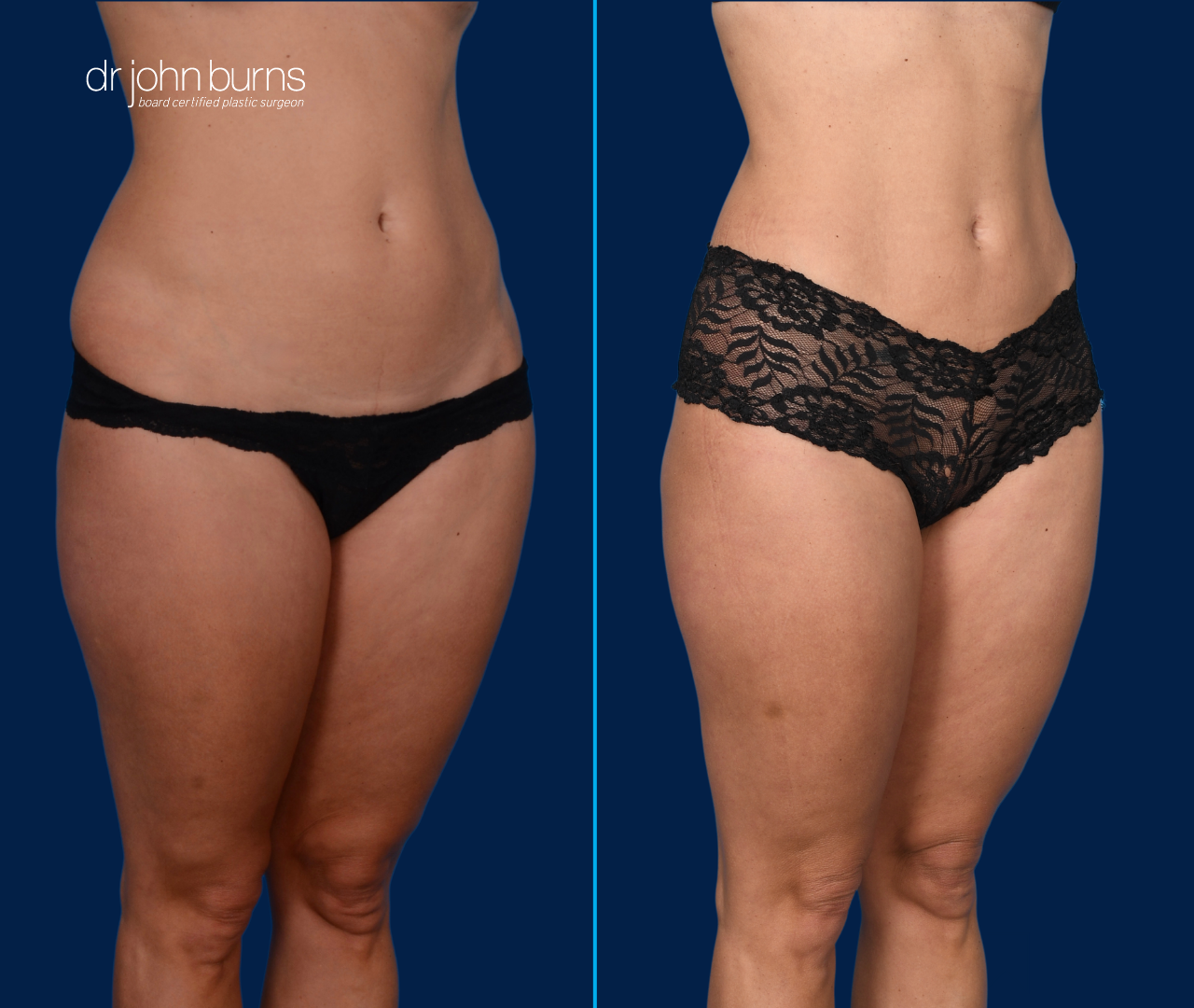 Case 2- 45 Degree View | Before & After Mini Tummy Tuck with Abdominal Etching by Dallas Plastic Surgeon, Dr. John Burns