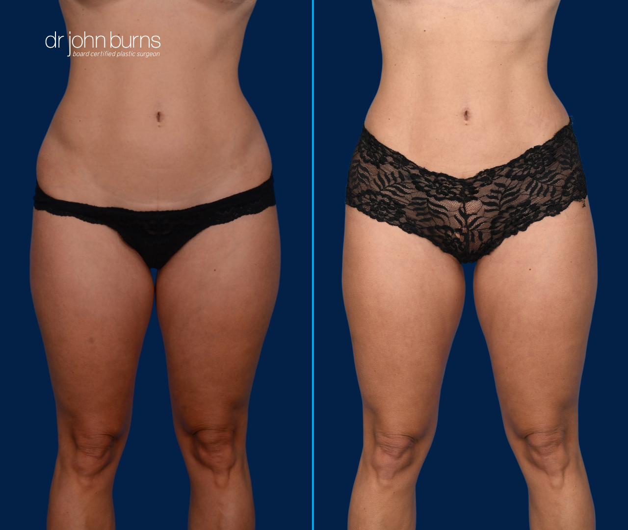 Case 2- Frontal View | Before & After Mini Tummy Tuck with Abdominal Etching by Dallas Plastic Surgeon, Dr. John Burns