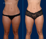 Before and after Corset Tummy Tuck with lipo 360- Dallas Tummy Tuck- Dr. John Burns