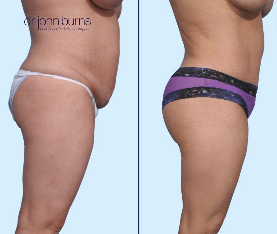 Case 10- Profile View-Before & After Tummy Tuck, BBL, Lipo 360 by Dr. John Burns