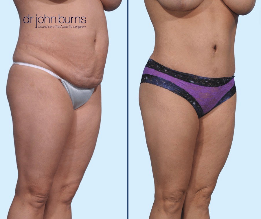 Case 10- 45 Degree View- Before & After Tummy Tuck, BBL, Lipo 360 by Dr. John Burns