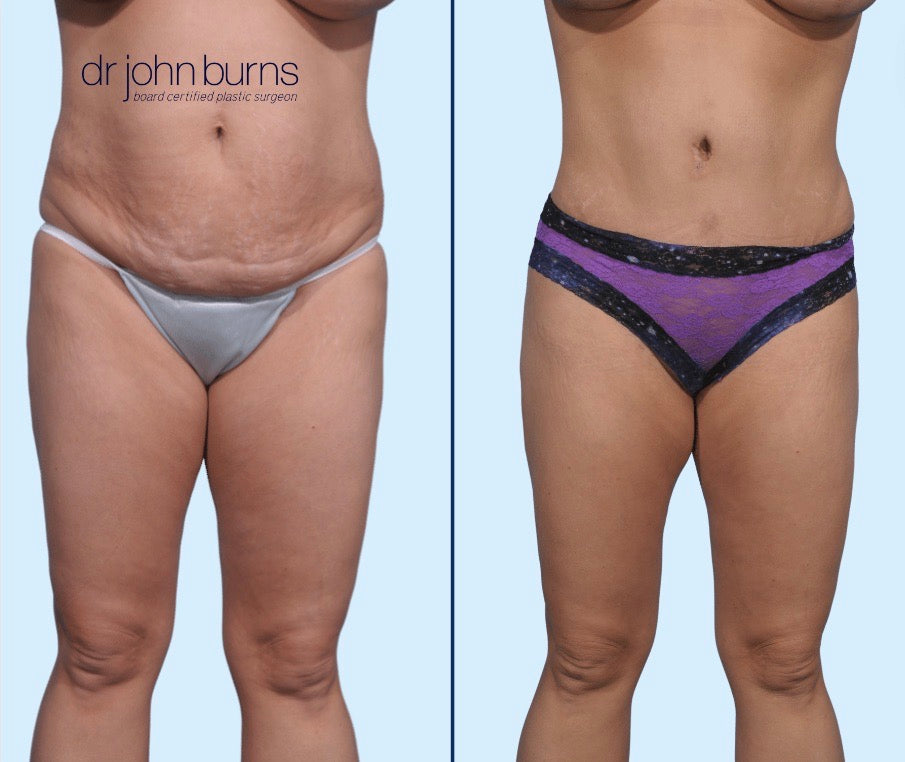 Case 10- Front View-Before & After Tummy Tuck, BBL, Lipo 360 by Dr. John Burns