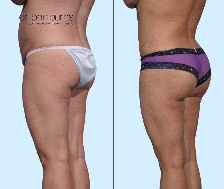 Case 10- Left Back View-Before & After Tummy Tuck, BBL, Lipo 360 by Dr. John Burns