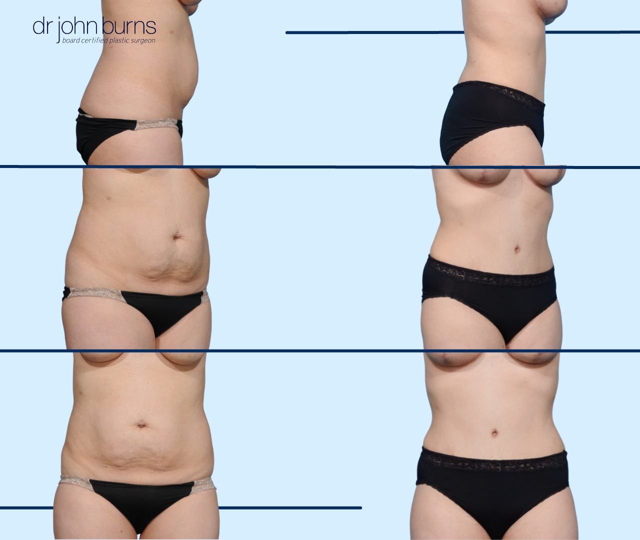 The Bikini Incision- How Low Can You Go? by Dr. John Burns – Dr John Burns