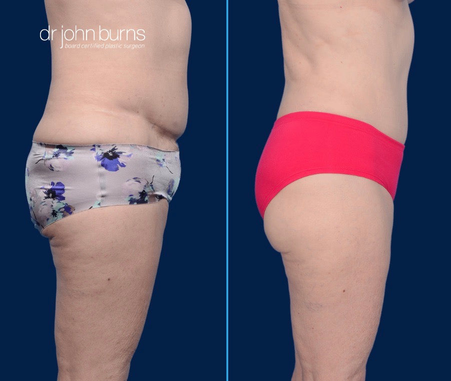 Case 11- Profile View- Before & After Tummy Tuck Revision with Liposuction by Dr. John Burns