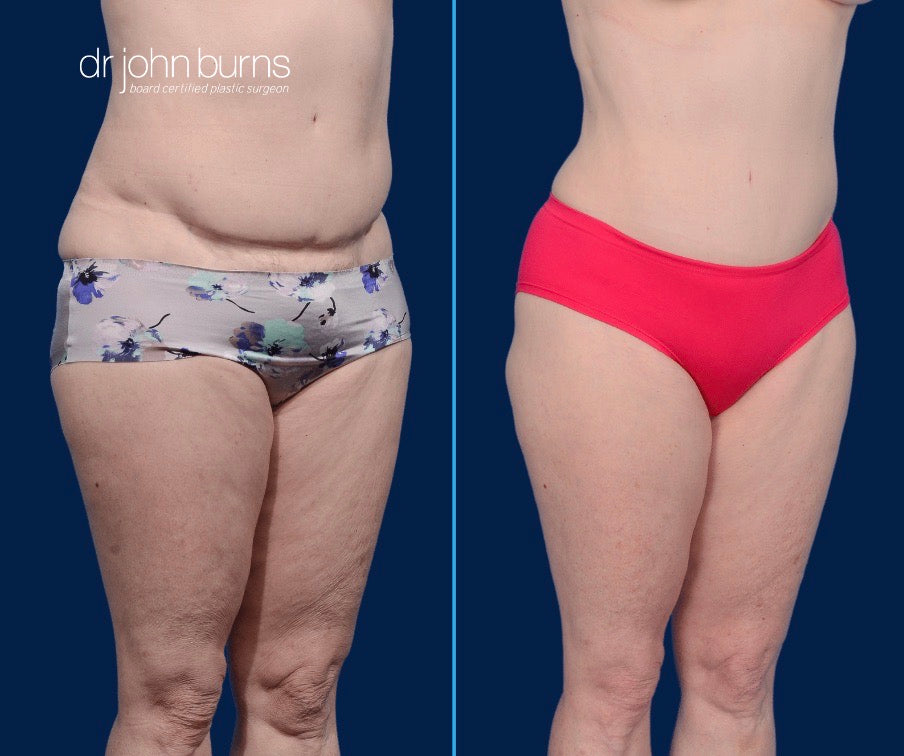 Case 11- 45 Degree View- Before & After Tummy Tuck Revision with Liposuction by Dr. John Burns