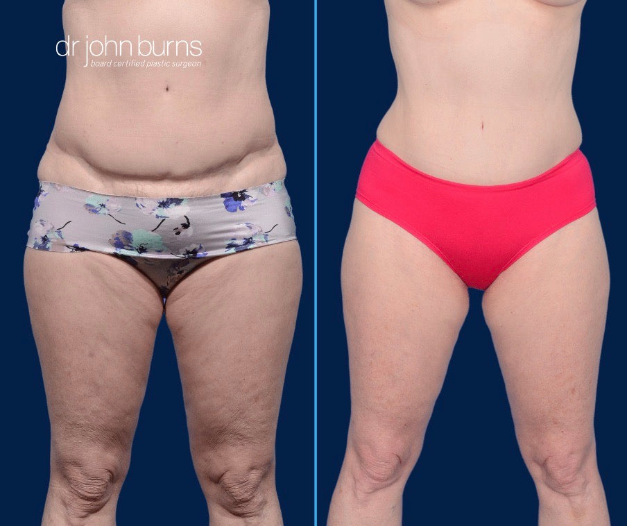 Case 11- Front View- Before & After Tummy Tuck Revision with Liposuction by Dr. John Burns