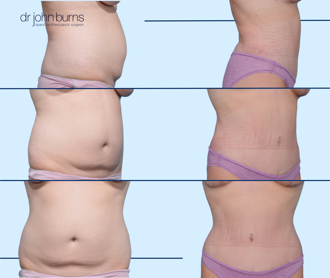 Dallas Tummy Tuck Before & After Results by Dr. John Burns – Dr