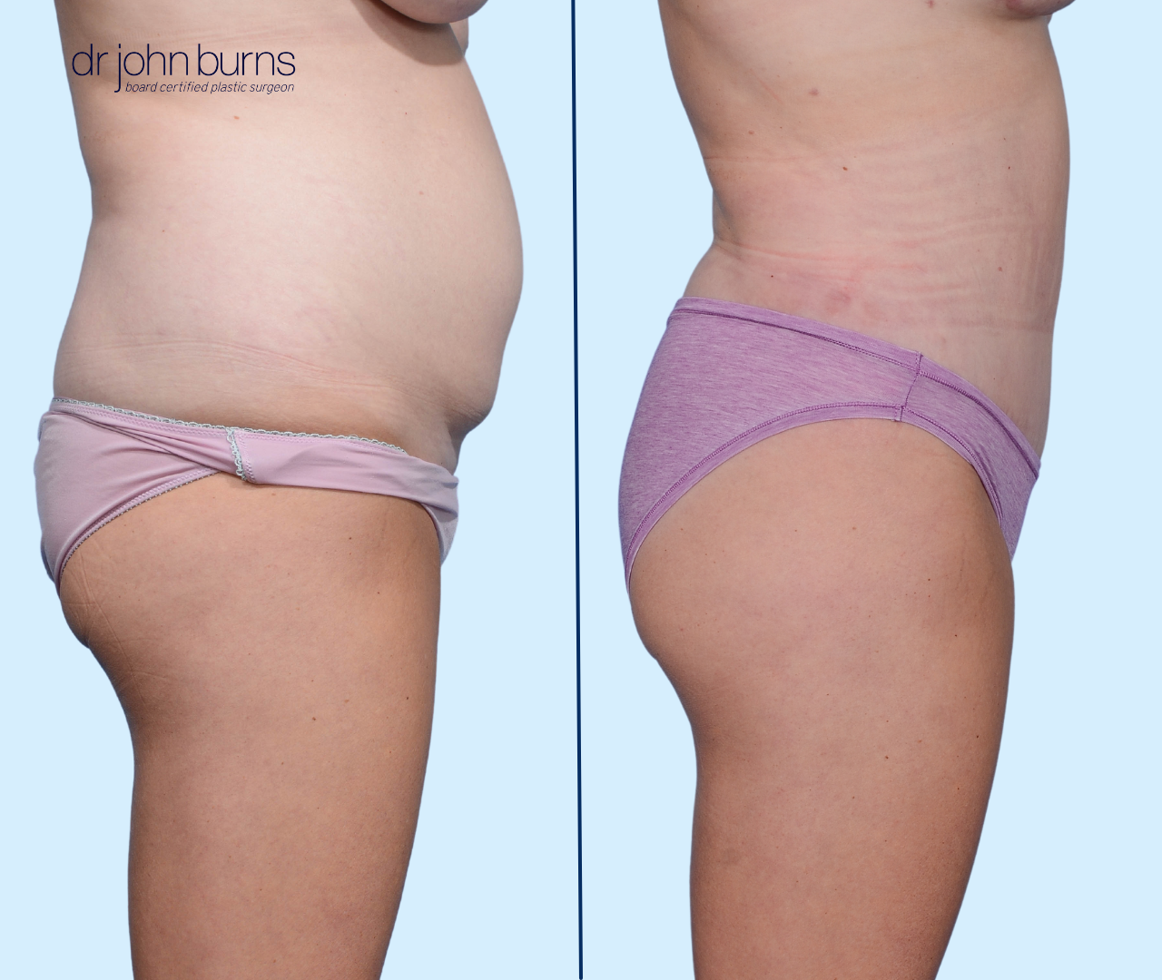 Case 3- Profile View | Before and After Standard Tummy Tuck with liposuction by Dr. John Burns