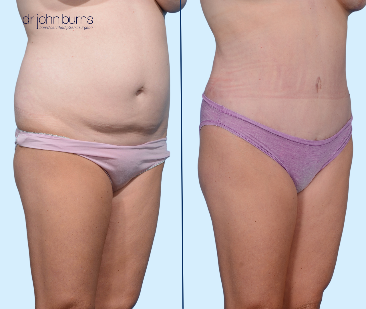 Case 3 | 45 Degree View | Before and After Standard Tummy Tuck with liposuction by Dr. John Burns