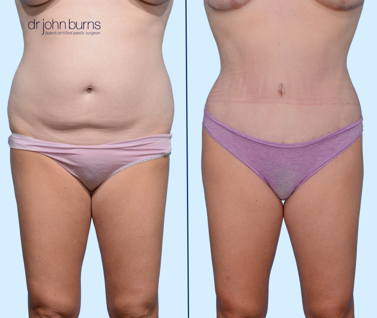 Case 3 | Front View | Before and After Standard Tummy Tuck with liposuction by Dr. John Burns