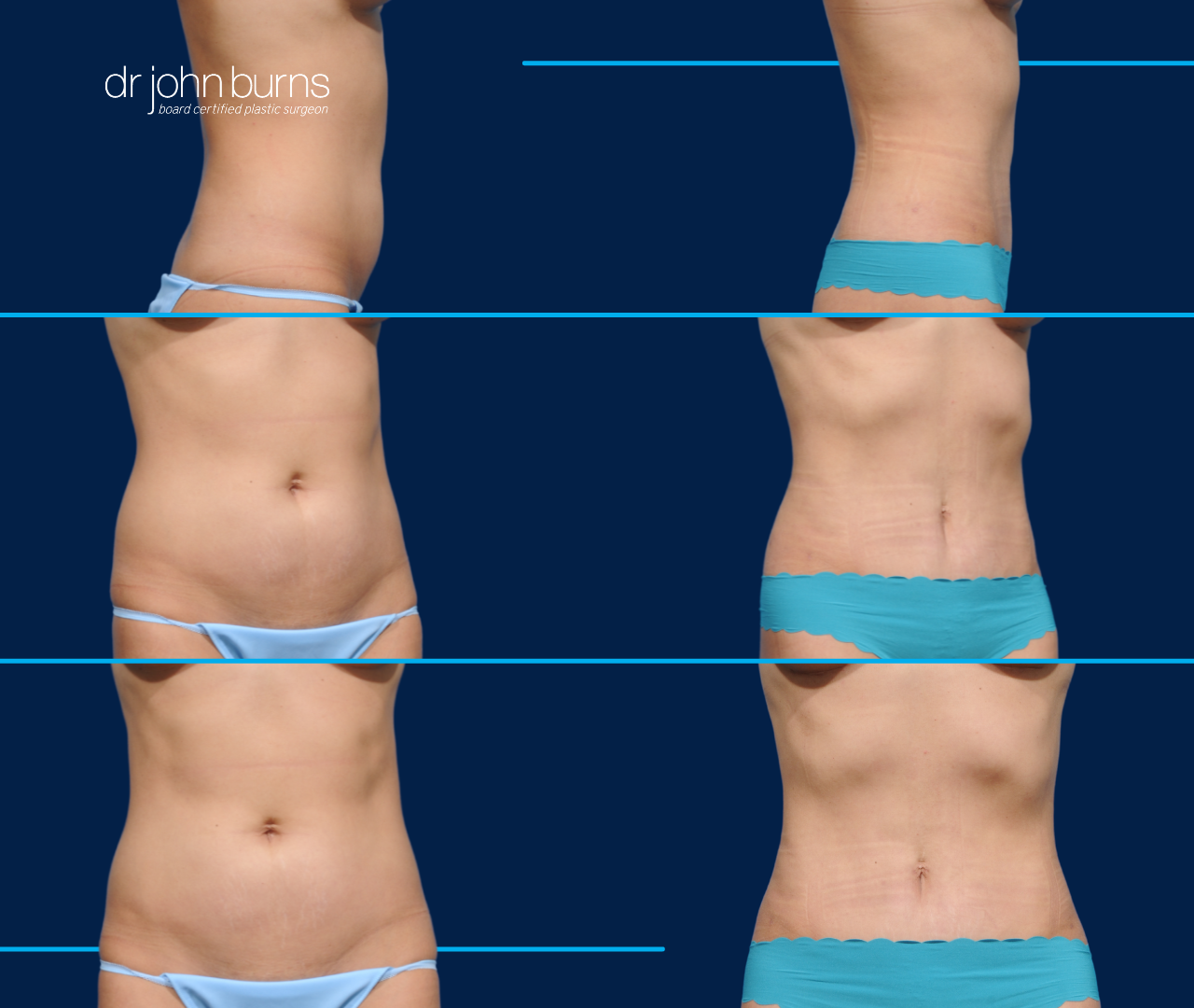 Case 4- Before & After Mini Tummy Tuck with Umbilical Float and Lipo 360 by Dr. John Burns