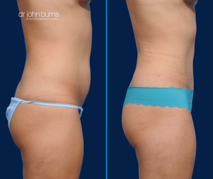 Case 4- Profile View-Before & After Mini Tummy Tuck with Umbilical Float and Lipo 360 by Dr. John Burns