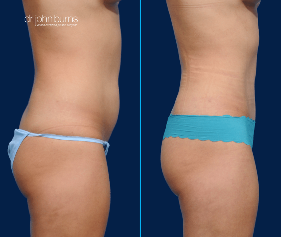 Corset Tummy Tuck- Lipo 360 by Dallas Plastic Surgeon Dr. John Burns – Dr  John Burns