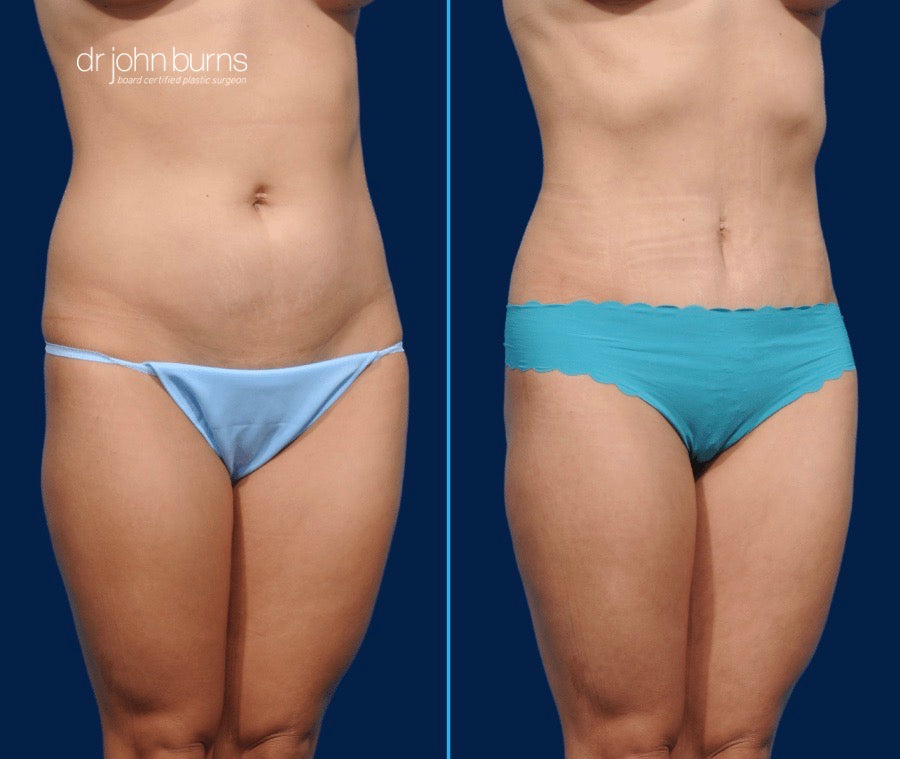 Case 4- 45 Degree View- Before & After Mini Tummy Tuck with Umbilical Float and Lipo 360 by Dr. John Burns