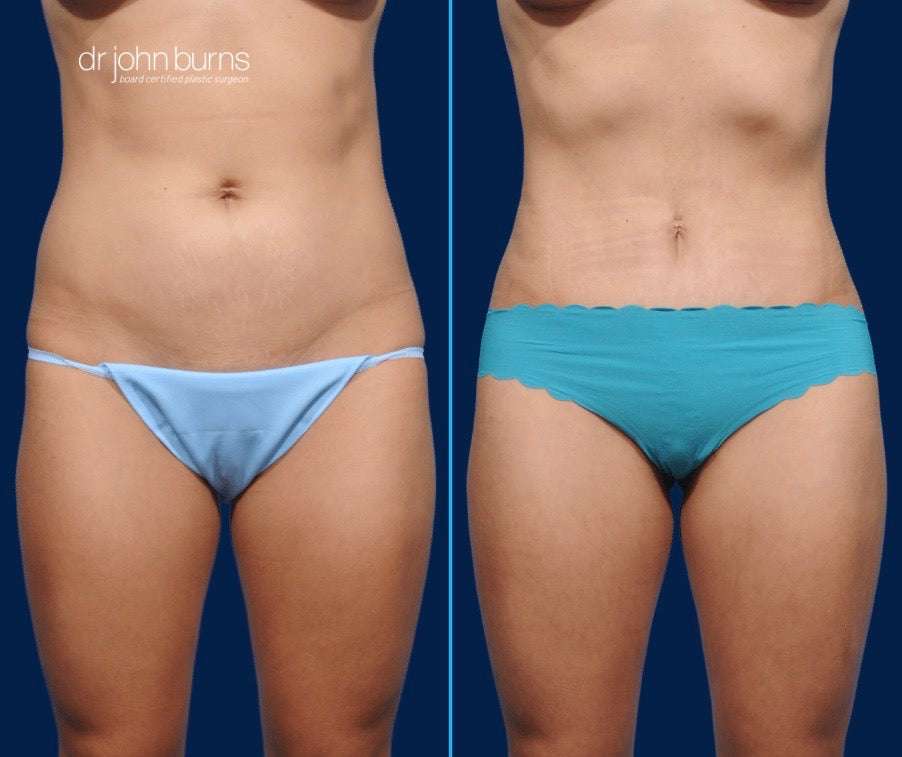 Case 4- Front View- Before & After Mini Tummy Tuck with Umbilical Float and Lipo 360 by Dr. John Burns
