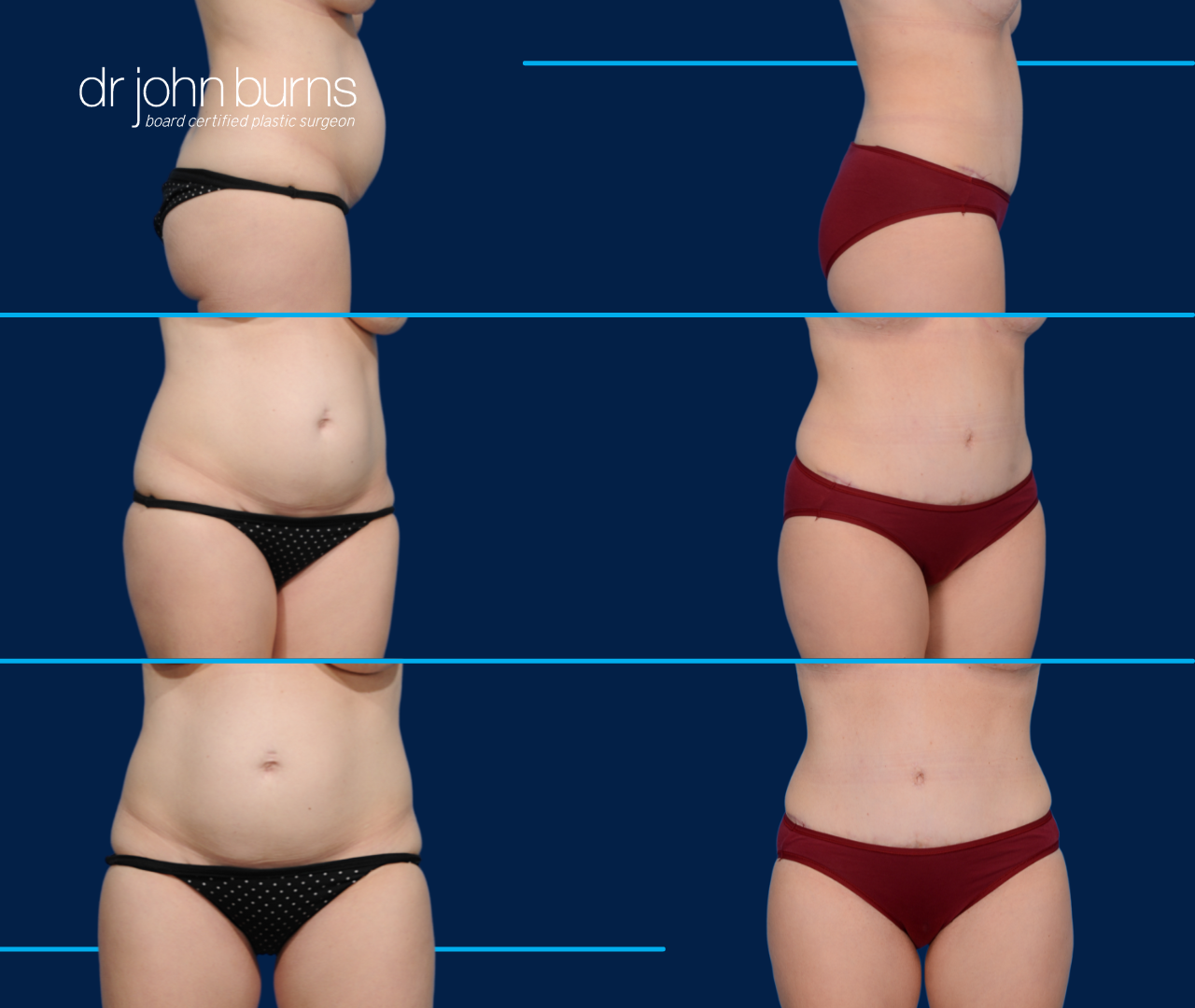 Case 5- Before and After Standard Tummy Tuck with Lipo 360 by Dr. John Burns