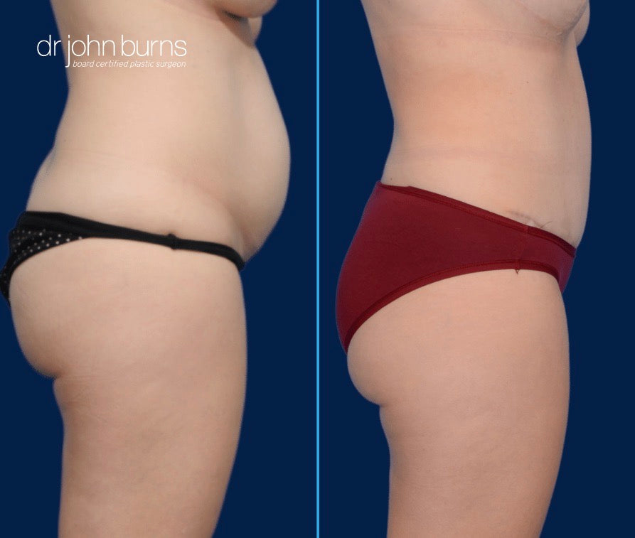 Case 5- Profile View- Before and After Standard Tummy Tuck with Lipo 360 by Dr. John Burns
