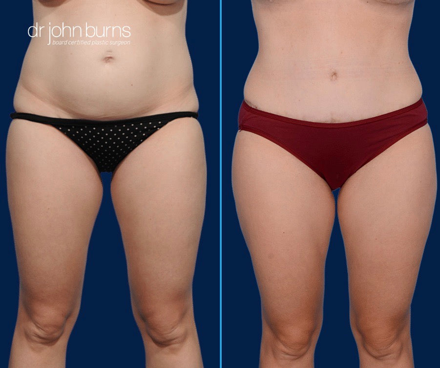 Dallas Tummy Tuck Before & After Results by Dr. John Burns – Dr John Burns