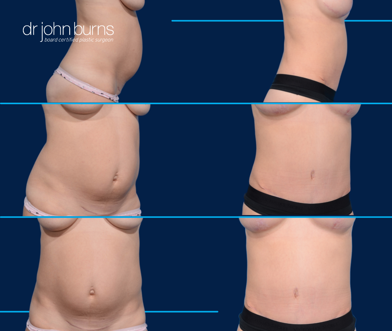 Case 6- Before and After Standard Tummy Tuck with Lipo 360 by Dr. John Burns
