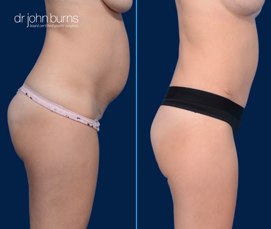 Case 6- Profile View- Before and After Standard Tummy Tuck with Lipo 360 by Dr. John Burns