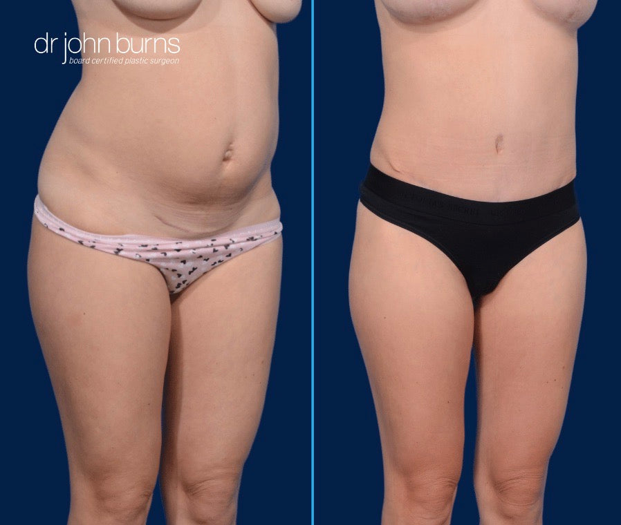 Case 6- 45 Degree View- Before and After Standard Tummy Tuck with Lipo 360 by Dr. John Burns