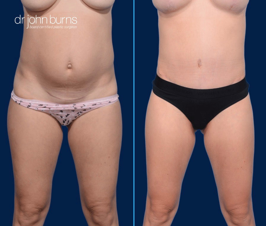 Case 6- Front View- Before and After Standard Tummy Tuck with Lipo 360 by Dr. John Burns