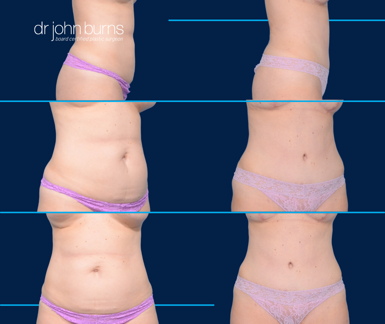 Case 7- Before & After Mini Tummy Tuck with Lipo 360 by Dr. John Burns