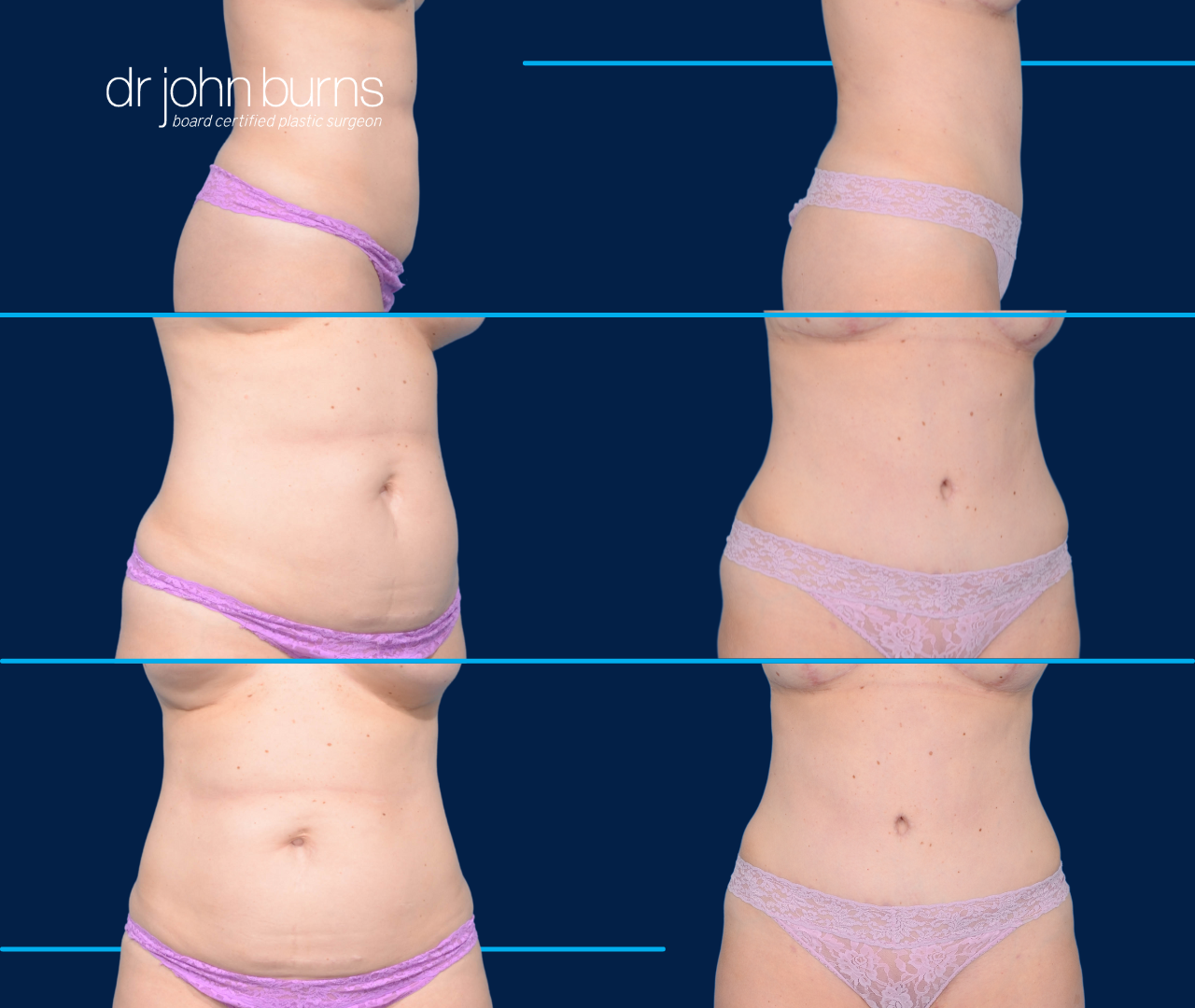 Best Mini Tummy Tuck- Dallas-Top Plastic Surgeon, Dr. John Burns