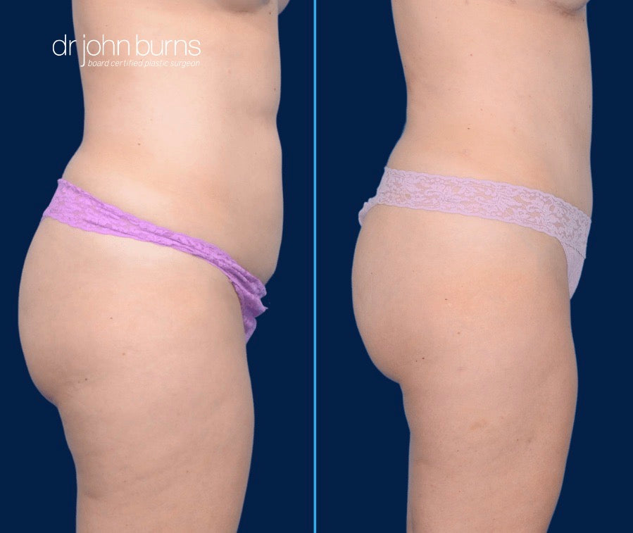 Case 7- Profile View- Before & After Mini Tummy Tuck with Lipo 360 by Dr. John Burns