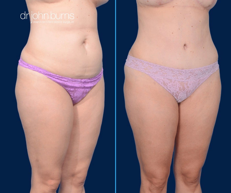 Case 7- 45 Degree View- Before & After Mini Tummy Tuck with Lipo 360 by Dr. John Burns