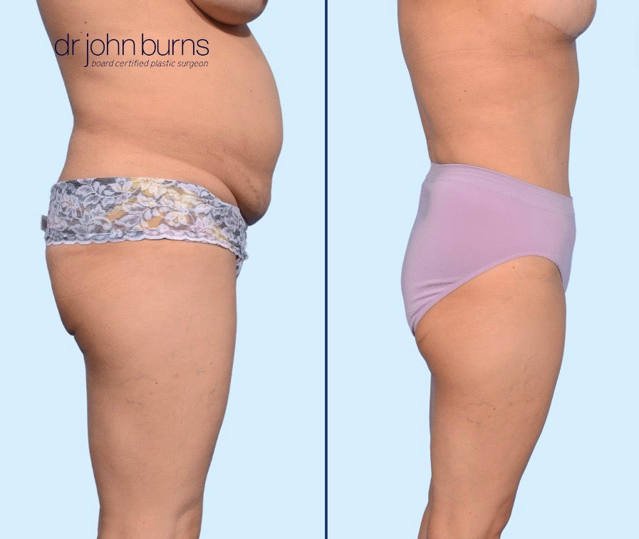 Case 8- Profile View- Before and After Tummy Tuck with LIpo 360, Dallas, Texas